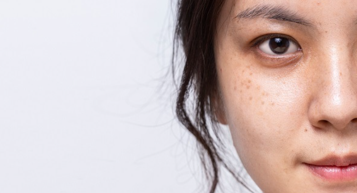 Cara Menghilangkan Flek Hitam untuk Semua Jenis Kulit
